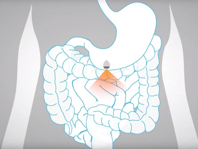 Nova revolucionarna kapsula je spas za milione dijabetièara VIDEO